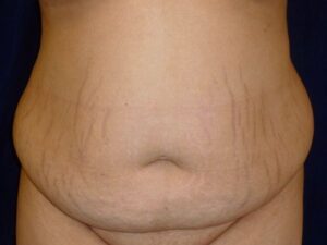before tummy tuck front view female patient case 3409
