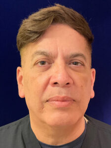 after Potenza RF Microneedling front view male patient case 3661