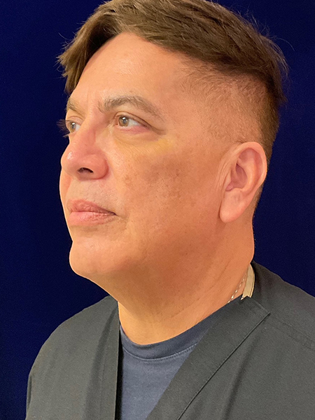 after Potenza RF Microneedling left angle view male patient case 3661
