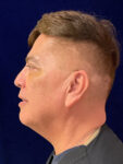 after Potenza RF Microneedling left view male patient case 3661