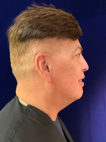 after Potenza RF Microneedling right view male patient case 3661
