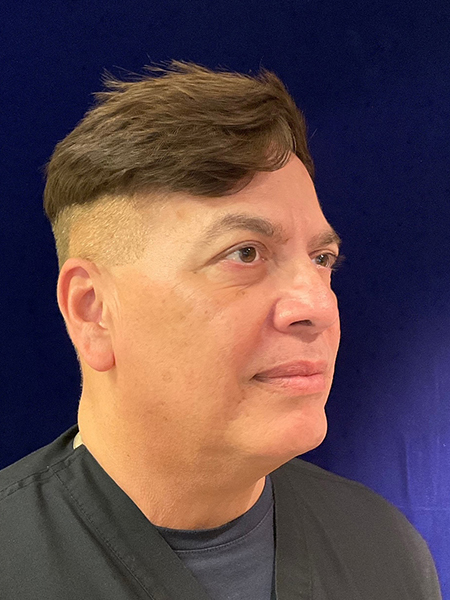 after Potenza RF Microneedling right angle view male patient case 3661