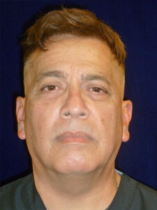 before Potenza RF Microneedling front view male patient case 3661