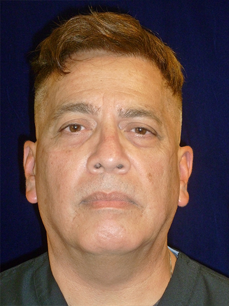 before Potenza RF Microneedling front view male patient case 3661