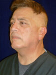 before Potenza RF Microneedling left angle view male patient case 3661