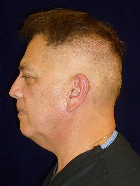 before Potenza RF Microneedling left view male patient case 3661