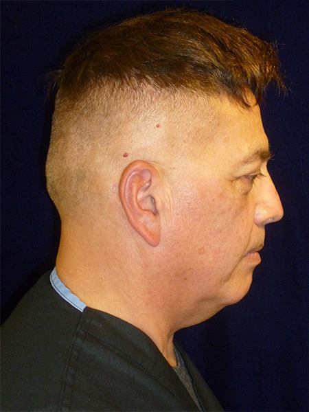 before Potenza RF Microneedling right view male patient case 3661