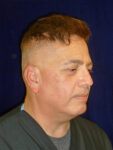 before Potenza RF Microneedling right angle view male patient case 3661