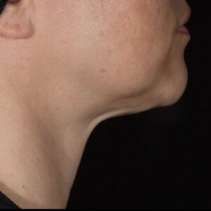 after Potenza RF Microneedling right angle view female patient case 3706