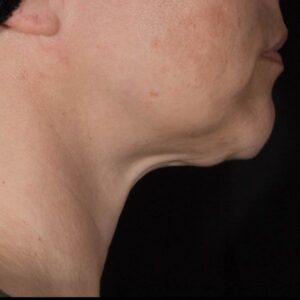 before Potenza RF Microneedling right angle view female patient case 3706