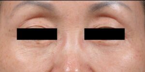 after Potenza RF Microneedling front view female patient case 3711