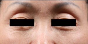 before Potenza RF Microneedling front view female patient case 3711