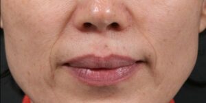 after Potenza RF Microneedling front view female patient case 3714