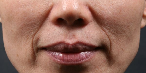 before Potenza RF Microneedling front view female patient case 3714