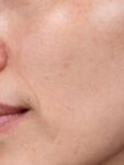 after Potenza RF Microneedling left closeup view female patient case 3717