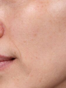 after Potenza RF Microneedling left closeup view female patient case 3717