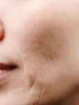 before Potenza RF Microneedling left closeup view female patient case 3717