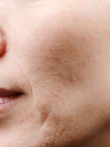 before Potenza RF Microneedling left closeup view female patient case 3717