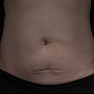 after Potenza RF Microneedling front view female patient case 3721