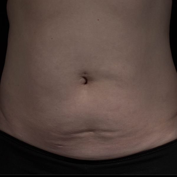 after Potenza RF Microneedling front view female patient case 3721
