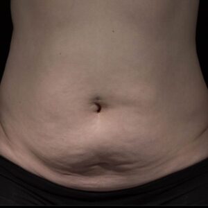 before Potenza RF Microneedling front view female patient case 3721