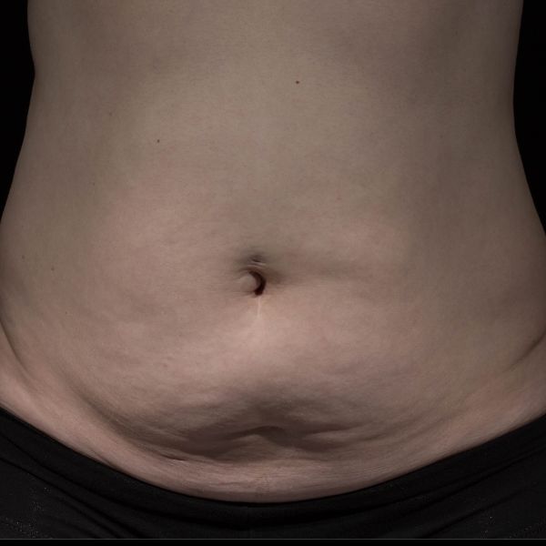 before Potenza RF Microneedling front view female patient case 3721