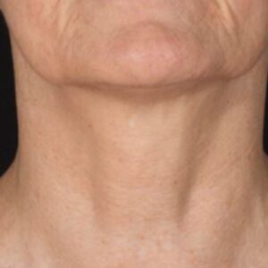 after Potenza RF Microneedling front view female patient case 3724