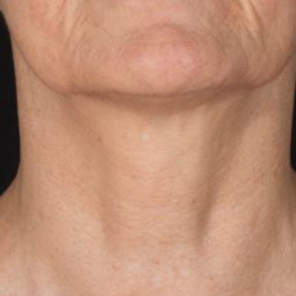 after Potenza RF Microneedling front view female patient case 3724