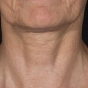 before Potenza RF Microneedling front view female patient case 3724