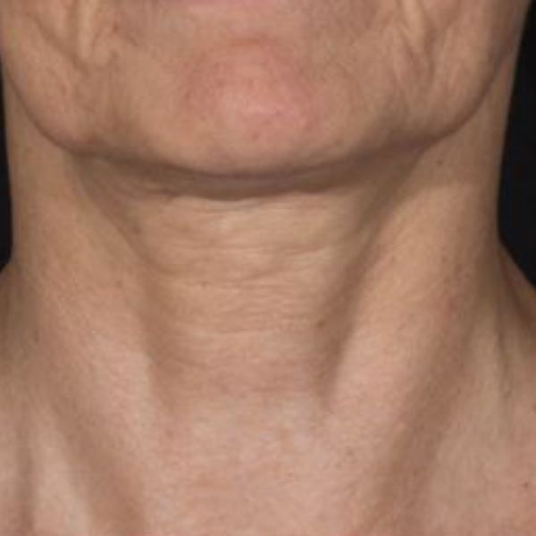 before Potenza RF Microneedling front view female patient case 3724