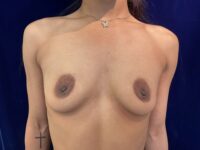 before breast augmentation front view female patient case 4037