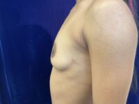 before breast augmentation left view female patient case 4037