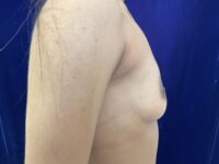 before breast augmentation right view female patient case 4037