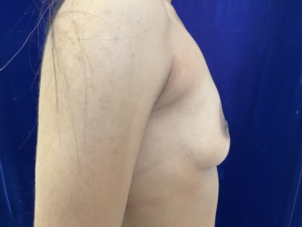 before breast augmentation right view female patient case 4037