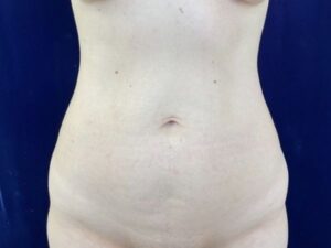 before liposuction front view female patient case 4048