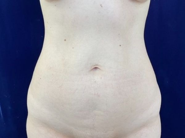 before liposuction front view female patient case 4048