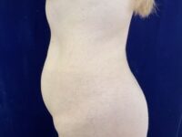 before liposuction left view female patient case 4048