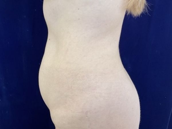 before liposuction left view female patient case 4048