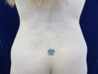 before liposuction back view female patient case 4048
