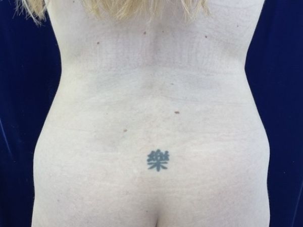 before liposuction back view female patient case 4048