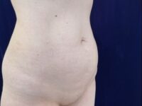 before liposuction right angle view female patient case 4048