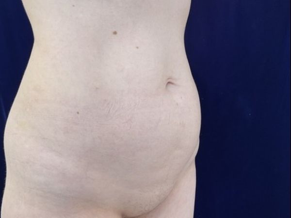 before liposuction right angle view female patient case 4048
