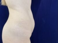 before liposuction right view female patient case 4048