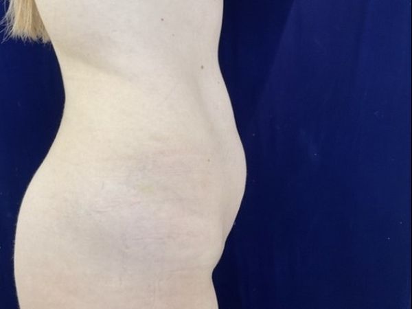 before liposuction right view female patient case 4048