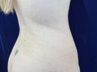 before liposuction right angle view female patient case 4048