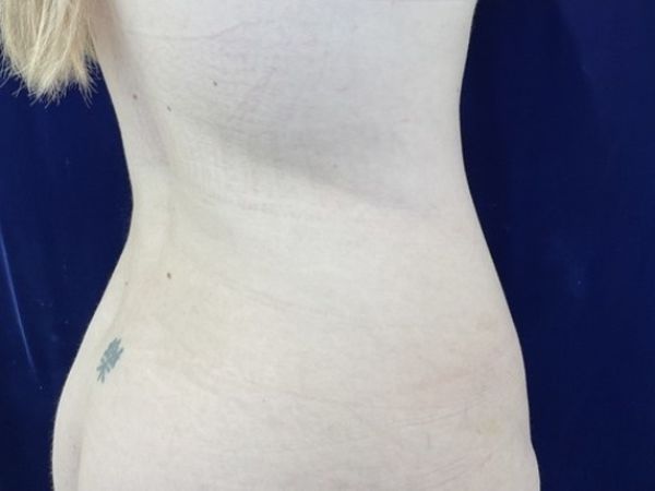 before liposuction right angle view female patient case 4048