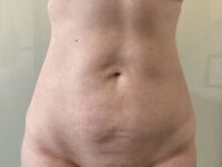 after liposuction front view female patient case 4048