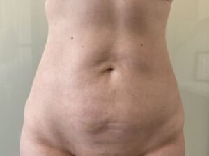 after liposuction front view female patient case 4048