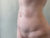 after liposuction left angle view female patient case 4048