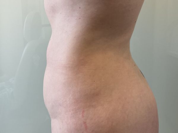 after liposuction left view female patient case 4048